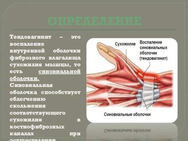 ОПРЕДЕЛЕНИЕ Тендовагинит – это воспаление внутренней оболочки фиброзного влагалища сухожилия мышцы, то