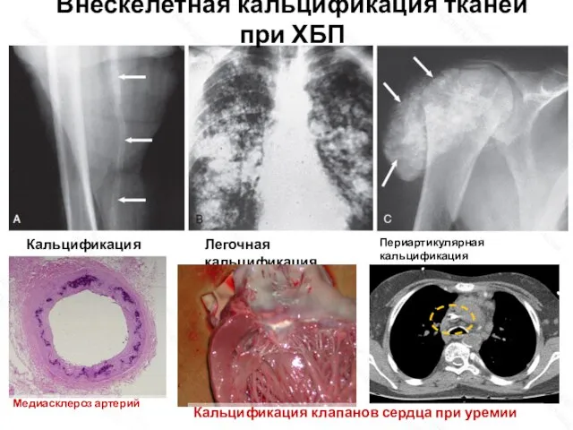 Внескелетная кальцификация тканей при ХБП Кальцификация артерий Легочная кальцификация Периартикулярная кальцификация Медиасклероз
