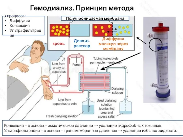 Гемодиализ. Принцип метода Полупроницаемая мембрана кровь Диализ. раствор Диффузия молекул через мембрану