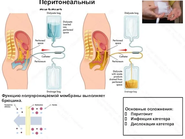 Перитонеальный диализ Функцию полупроницаемой мембраны выполняет брюшина. Основные осложнения: Перитонит Инфекция катетера Дислокация катетера