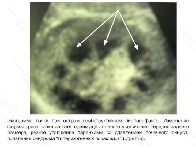 Эхограмма почки при остром необструктивном пиелонефрите. Изменение формы среза почки за счет