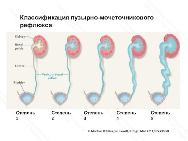 G.Montini, K.Tullus, Ian Hewitt, N Engl J Med 2011;365:239-50 Классификация пузырно-мочеточникового рефлюкса