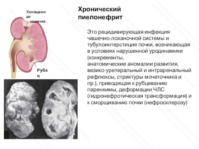 Уплощенная чашечка Рубец Хронический пиелонефрит Это рецидивирующая инфекция чашечно-лоханочной системы и тубулоинтерстиция