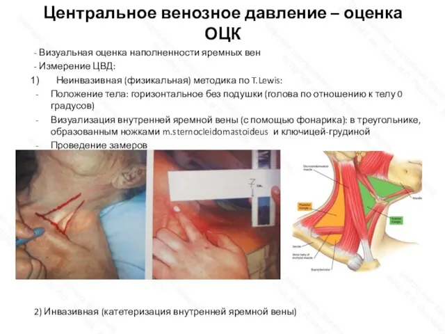 Центральное венозное давление – оценка ОЦК - Визуальная оценка наполненности яремных вен