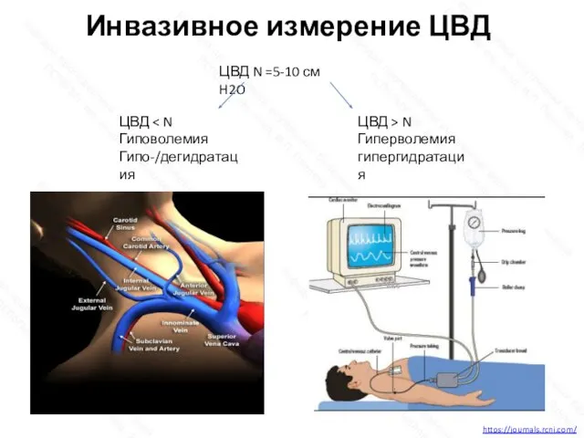 Инвазивное измерение ЦВД https://journals.rcni.com/ ЦВД N =5-10 см H2O ЦВД > N