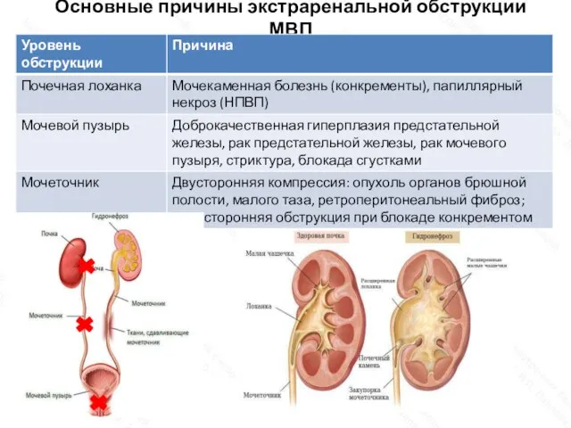 Основные причины экстраренальной обструкции МВП