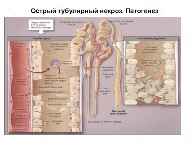 Острый тубулярный некроз. Патогенез