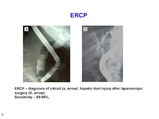 ERCP ERCP – diagnosis of calculi (а, arrow), hepatic duct injury after