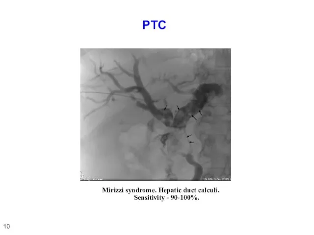 PTC Mirizzi syndrome. Hepatic duct calculi. Sensitivity - 90-100%. 10