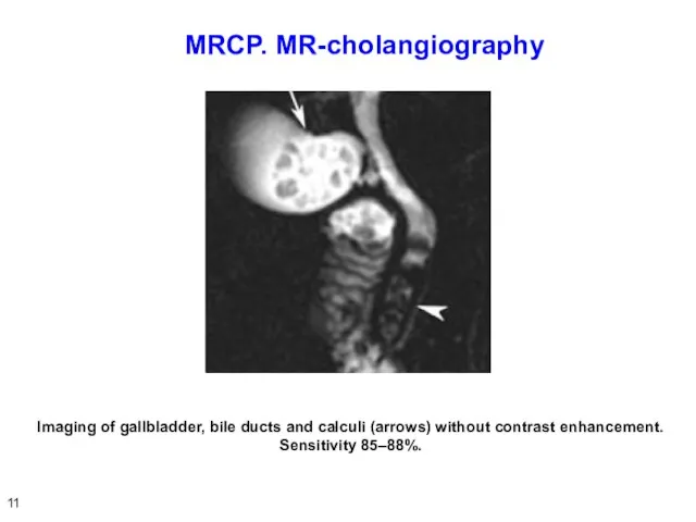 MRCP. МR-cholangiography Imaging of gallbladder, bile ducts and calculi (arrows) without contrast enhancement. Sensitivity 85–88%. 11