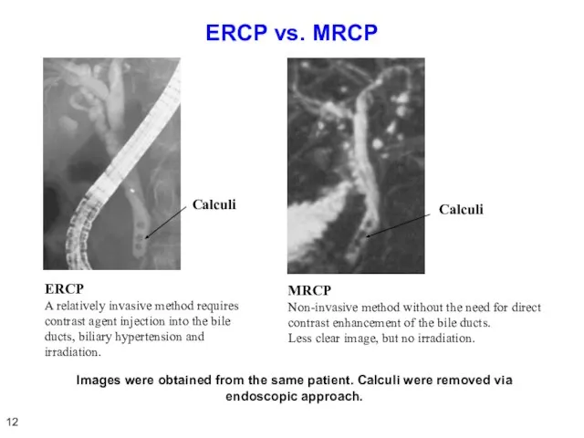 ERCP vs. MRCP ERCP A relatively invasive method requires contrast agent injection
