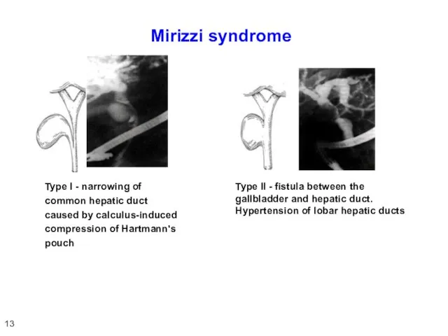 Mirizzi syndrome Type I - narrowing of common hepatic duct caused by