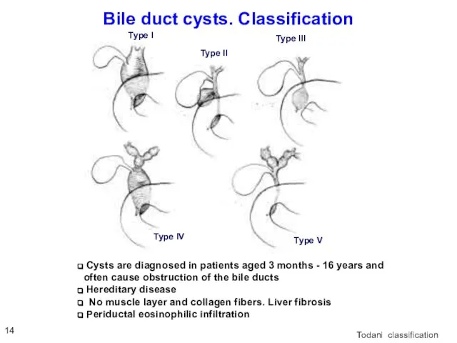 Bile duct cysts. Classification Todani classification Cysts are diagnosed in patients aged