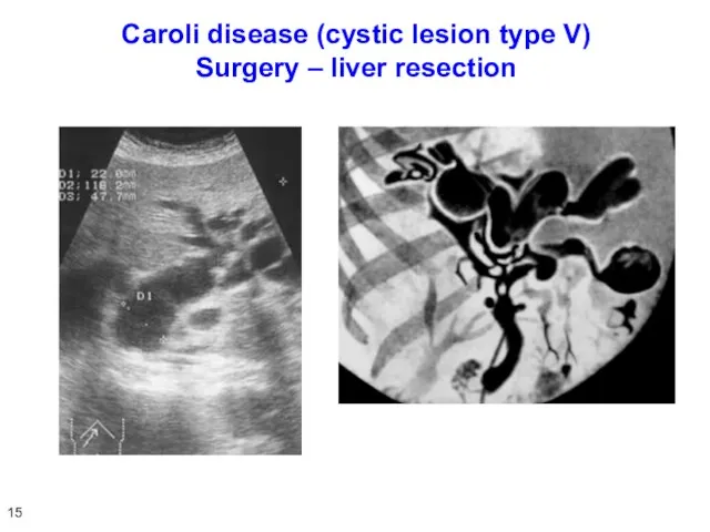 Caroli disease (cystic lesion type V) Surgery – liver resection 15