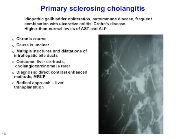 Primary sclerosing cholangitis Chronic course Cause is unclear Multiple strictures and dilatations