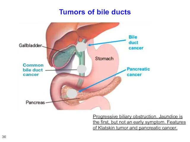 Tumors of bile ducts Progressive biliary obstruction. Jaundice is the first, but