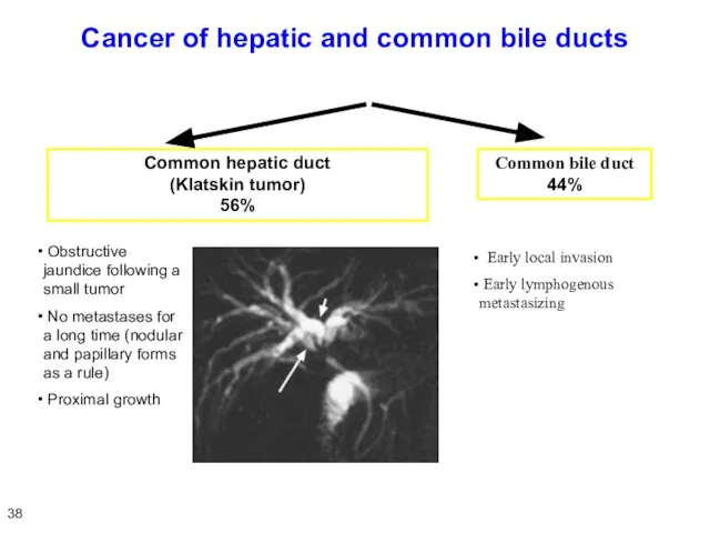 Cancer of hepatic and common bile ducts Common hepatic duct (Klatskin tumor)