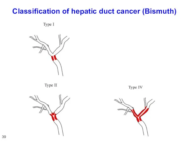 Classification of hepatic duct cancer (Bismuth) 39