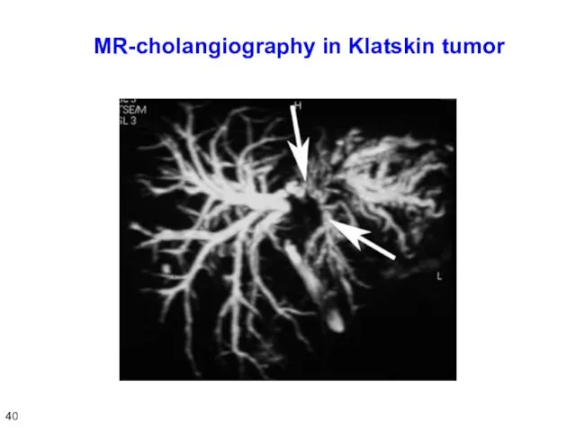 MR-cholangiography in Klatskin tumor 40