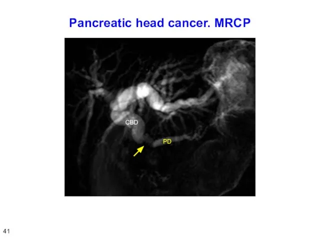 Pancreatic head cancer. MRCP 41