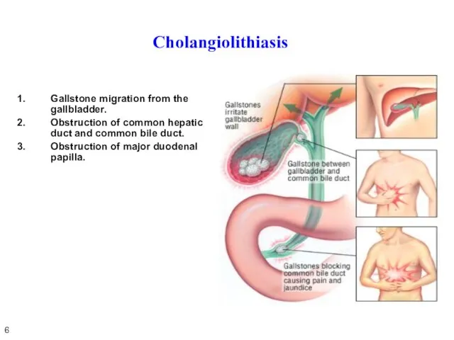 Cholangiolithiasis Gallstone migration from the gallbladder. Obstruction of common hepatic duct and