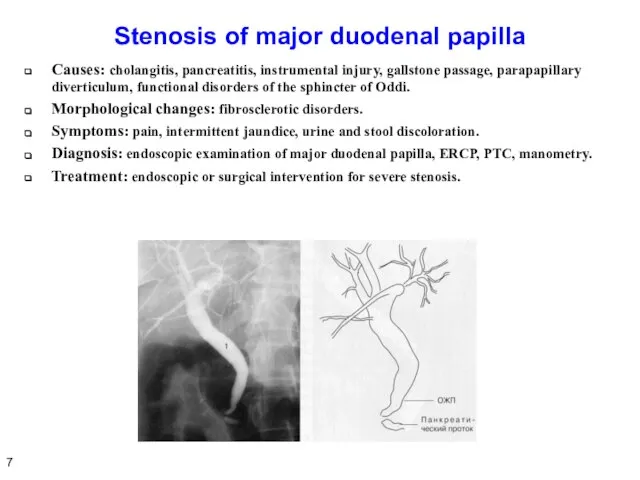 Stenosis of major duodenal papilla Causes: cholangitis, pancreatitis, instrumental injury, gallstone passage,