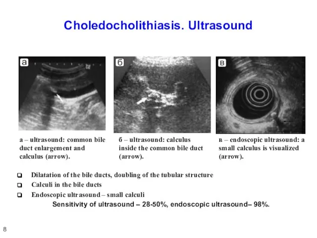 Choledocholithiasis. Ultrasound Dilatation of the bile ducts, doubling of the tubular structure