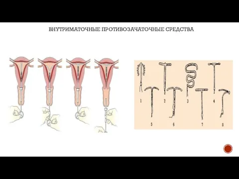 ВНУТРИМАТОЧНЫЕ ПРОТИВОЗАЧАТОЧНЫЕ СРЕДСТВА