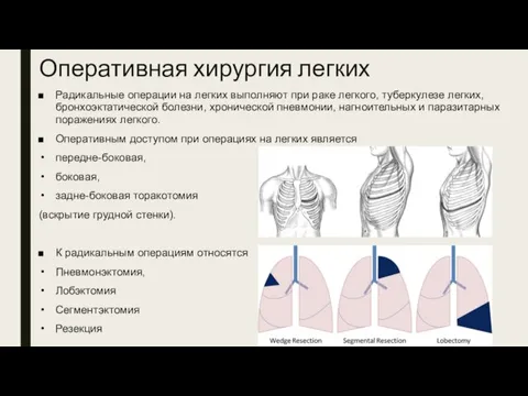 Оперативная хирургия легких Радикальные операции на легких выполняют при раке легкого, туберкулезе