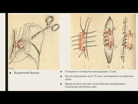 Выделение бронха Поперечно оси бронха накладывают 2 шва Бронх пересекают на 0,75
