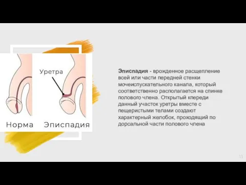 Эписпадия - врожденное расщепление всей или части передней стенки мочеиспускательного канала, который