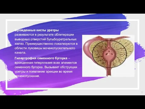 Врожденные кисты уретры развиваются в результате облитерации выводных отверстий бульбоуретральных желез. Преимущественно