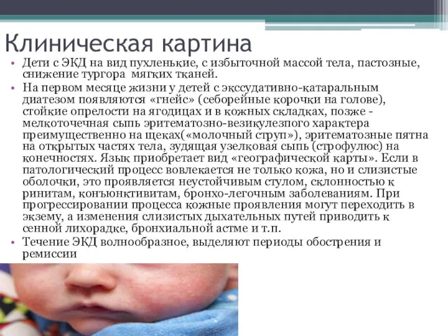 Клиническая картина Дети с ЭКД на вид пухленькие, с избыточной массой тела,