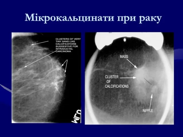 Мікрокальцинати при раку