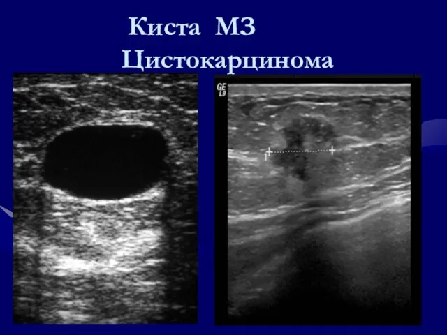 Киста МЗ Цистокарцинома