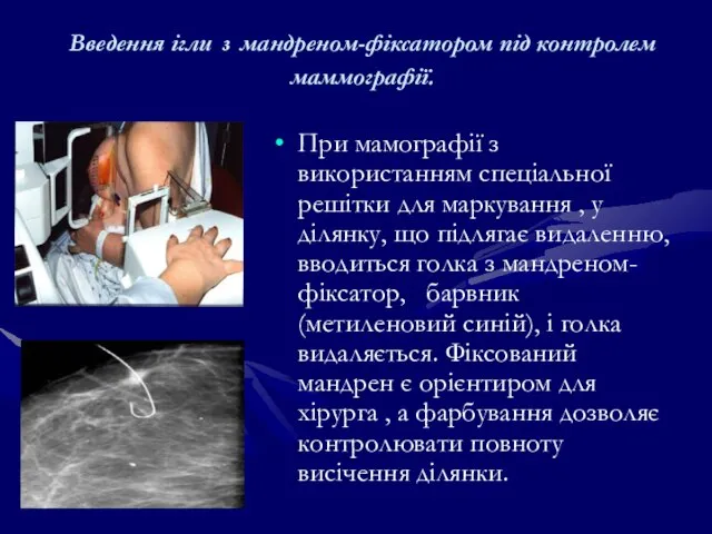 Введення ігли з мандреном-фіксатором під контролем маммографії. При мамографії з використанням спеціальної