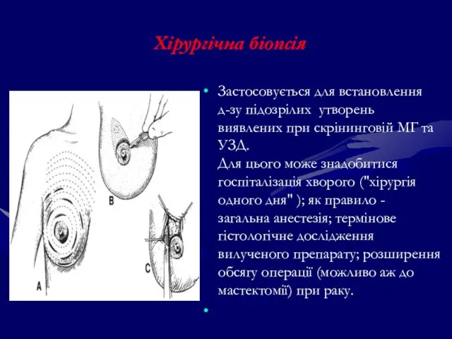 Хірургічна біопсія Застосовується для встановлення д-зу підозрілих утворень виявлених при скрінинговій МГ