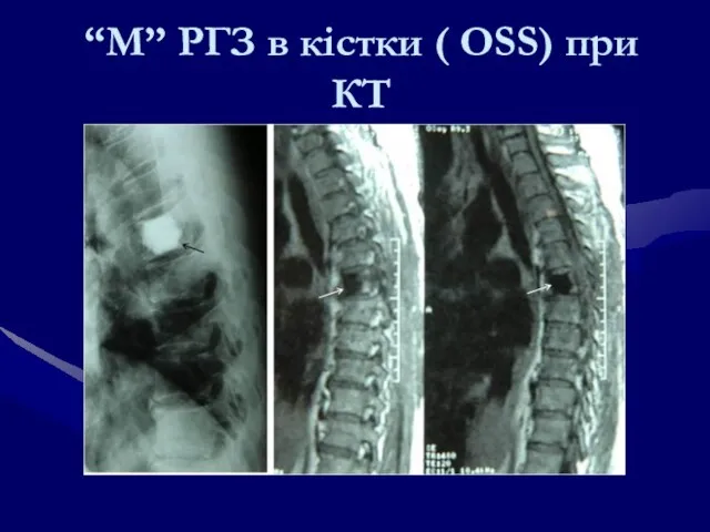 “М” РГЗ в кістки ( OSS) при КТ