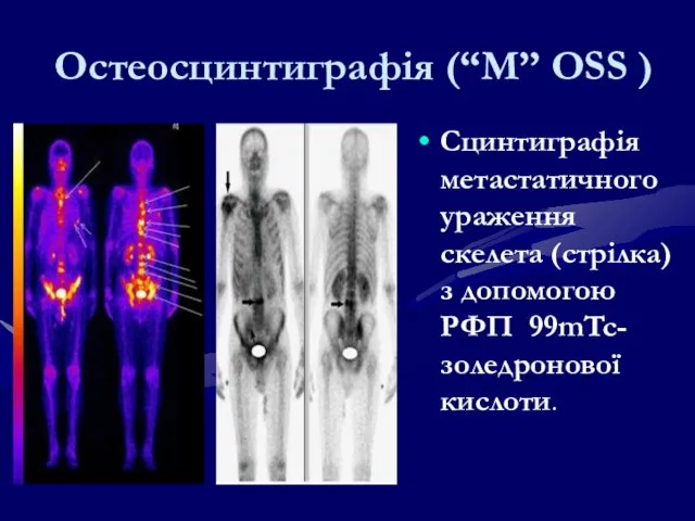 Остеосцинтиграфія (“М” OSS ) Сцинтиграфія метастатичного ураження скелета (стрілка) з допомогою РФП 99mTc-золедронової кислоти.