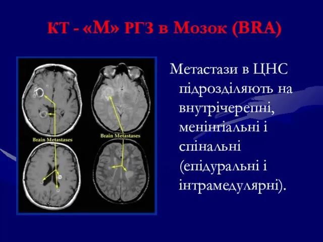 КТ - «М» РГЗ в Мозок (BRA) Метастази в ЦНС підрозділяють на