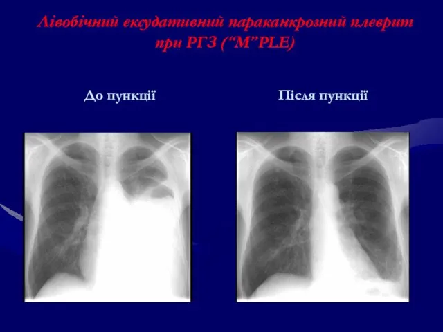 Лівобічний ексудативний параканкрозний плеврит при РГЗ (“М”PLE) До пункції Після пункції