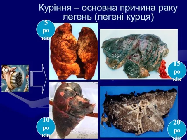 Куріння – основна причина раку легень (легені курця) 5 років 10 років 15 років 20 років