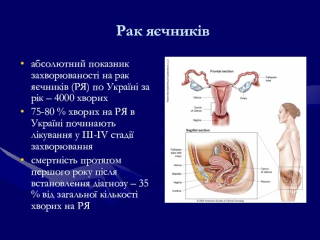 Рак яєчників абсолютний показник захворюваності на рак яєчників (РЯ) по Україні за