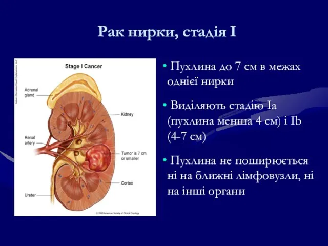 Рак нирки, стадія І Пухлина до 7 см в межах однієї нирки