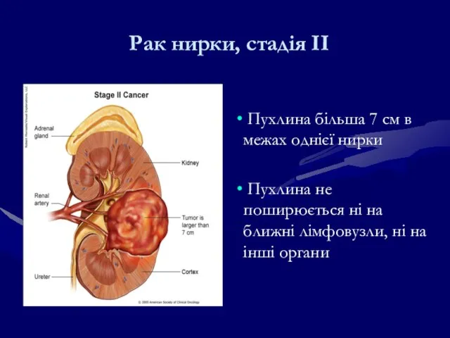 Рак нирки, стадія ІІ Пухлина більша 7 см в межах однієї нирки