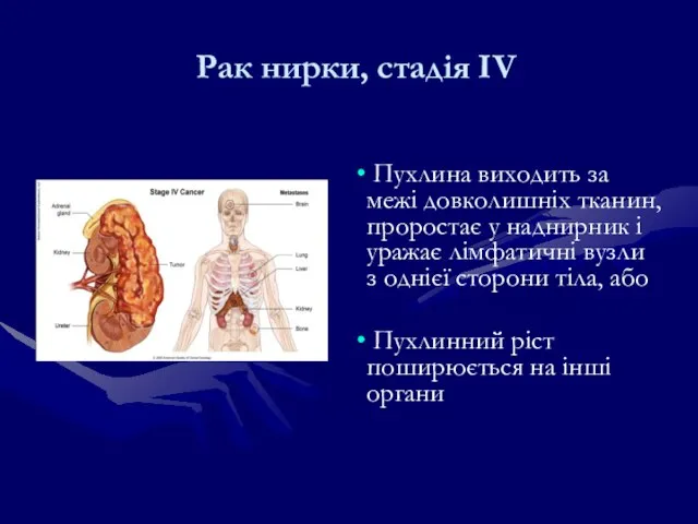 Рак нирки, стадія IV Пухлина виходить за межі довколишніх тканин, проростає у