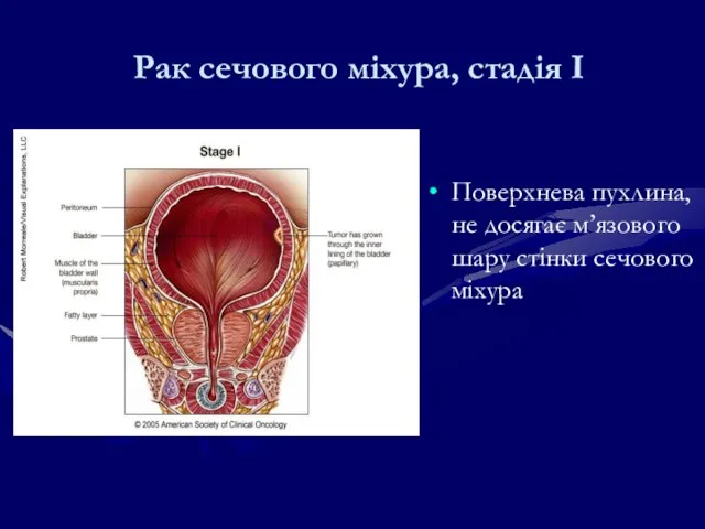 Рак сечового міхура, стадія І Поверхнева пухлина, не досягає м’язового шару стінки сечового міхура