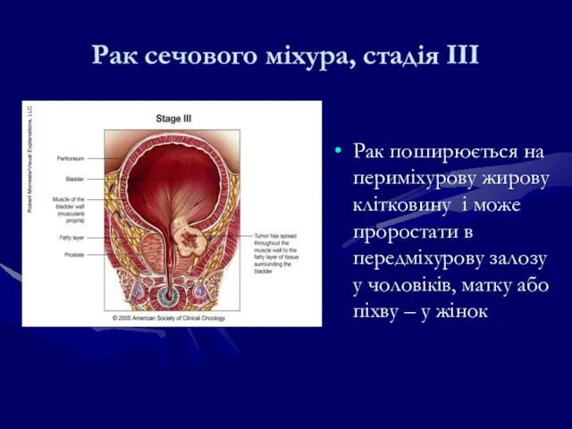 Рак поширюється на периміхурову жирову клітковину і може проростати в передміхурову залозу