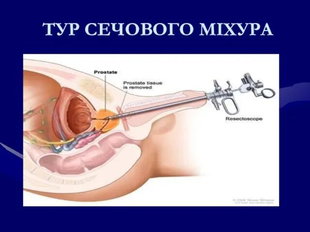 ТУР СЕЧОВОГО МІХУРА