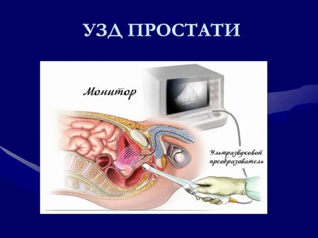 УЗД ПРОСТАТИ